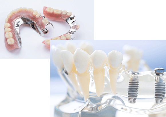 インプラントと義歯（入れ歯）はどちらがいい？