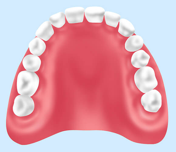 レジン床義歯（歯科用プラスチック）